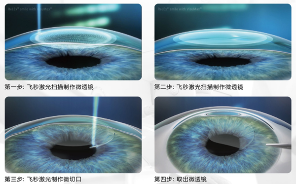 惠州希玛眼科医院全飞秒激光近视手术过程图