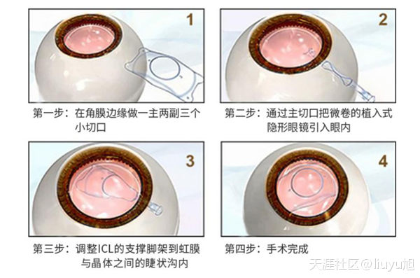 近视手术,ICL晶体植入术,惠州近视医院