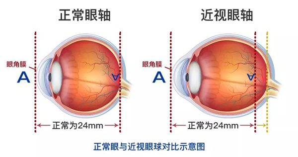 近视手术,ICL晶体植入手术,激光近视手术,惠州近视医院