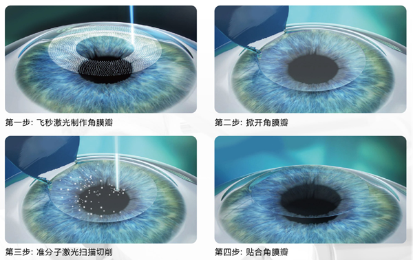 近视手术,惠州近视手术, 近视手术,惠州近视手术,